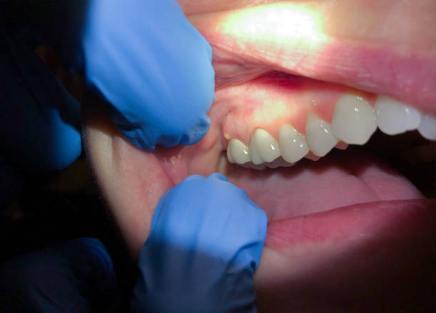 Best Emergency Dental Services for Seniors in Hyde, PA